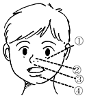 写真－小児のアレルギー性鼻炎のサイン